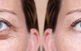 blepharoplastie superieure inferieure