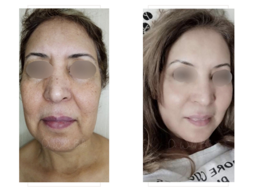 Protégé : Lifting cervico-facial, lipofilling, platysmaplastie et liposuccion du cou