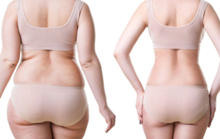 bon moment pour réaliser votre liposuccion