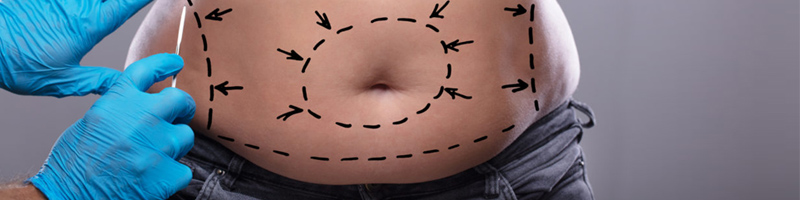 abdominoplastie en tunisie