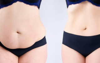 chirurgie ventre