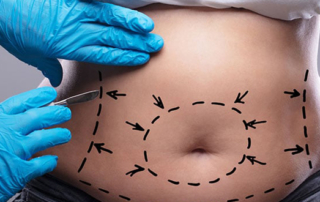 abdominoplastie balti