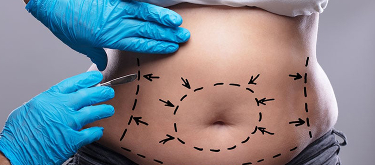 abdominoplastie balti