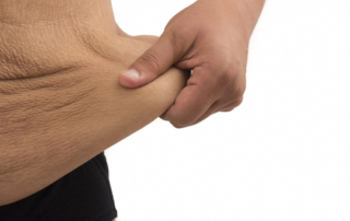 chirurgie peau relachee apres amaigrissement