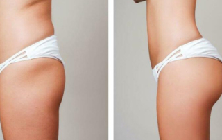 lipo