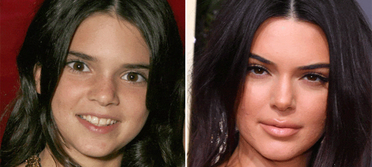 Kendall Jenner avant apres chirurgie esthetique