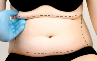 chirurgie esthétique gros ventre tunisie