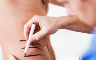 Les types d'implants les plus demandés chez les hommes