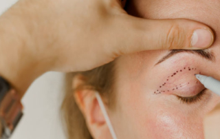 question reponse chirurgie paupieres