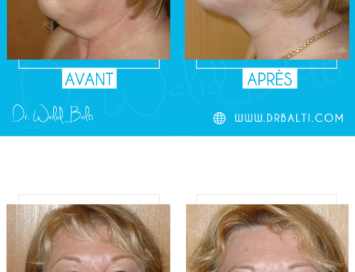 Lifting cervico-facial, liposuccion du cou & blépharoplastie