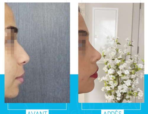 Rhinoplastie