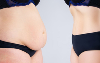 La meilleure façon de se débarrasser des gonflements après une abdominoplastie