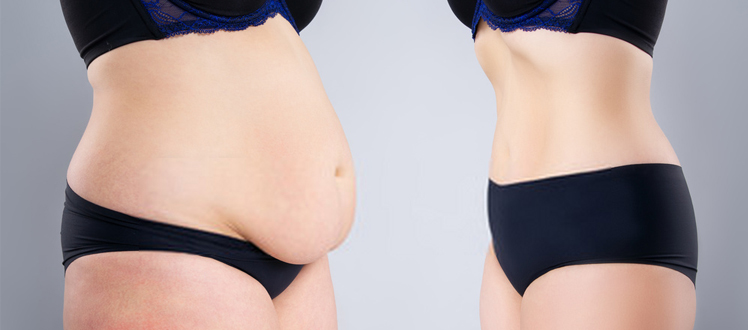 Quand enlever la gaine après une abdominoplastie? - Auxilium médicale