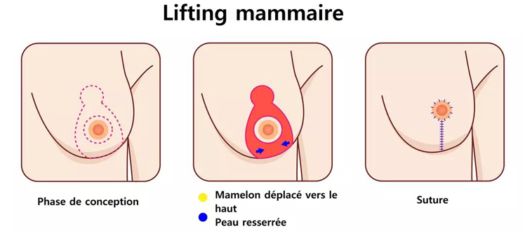 Les cicatrices du lifting mammaire