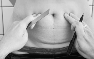 abdominoplastie-apres-grossesse-accouchement-tunisie