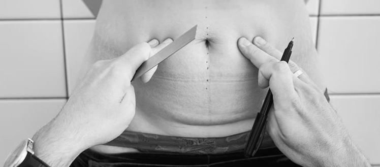 abdominoplastie-apres-grossesse-accouchement-tunisie