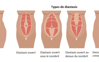 chirurgie tunisie diastasis schema