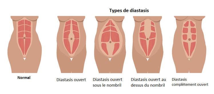 chirurgie tunisie diastasis schema