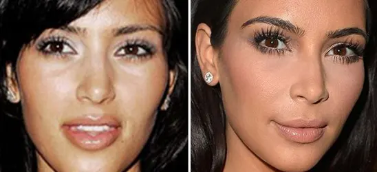 Kim-Kardashian-avant-apres-rhinoplastie