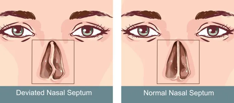 Septoplastie pour correction de la déviation de la cloison nasale