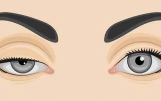 chirurgie-ptosis-oeil-tunisie