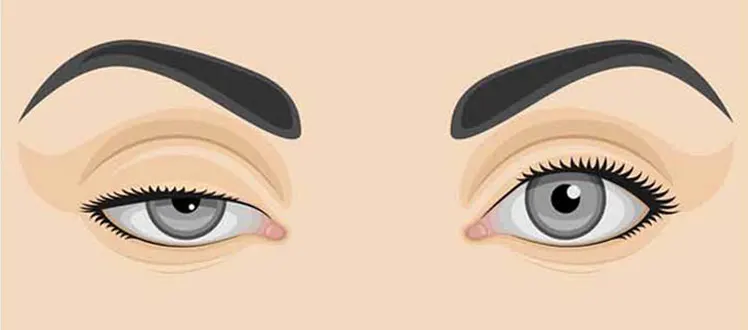 chirurgie-ptosis-oeil-tunisie