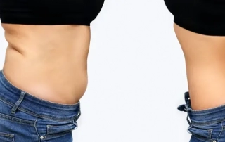 bienfaits-méconnus-chirurgie-abdominoplastie