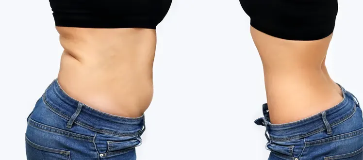 bienfaits-méconnus-chirurgie-abdominoplastie