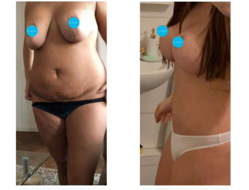 Révision de chirurgie mammaire, plastie abdominale & liposuccion du ventre