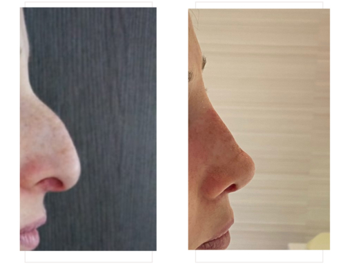 Rhinoplastie