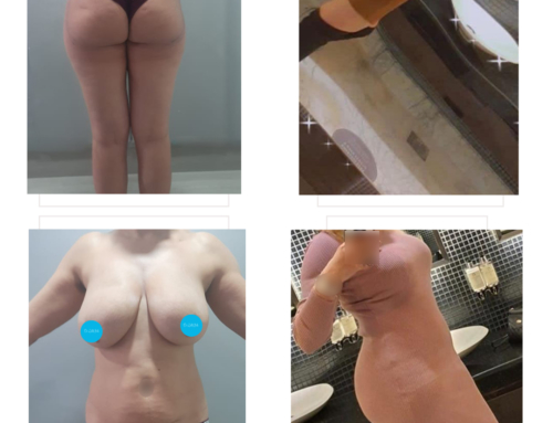 Lifting des seins, lipoaspiration, liposculpture & augmentaiton des fesses