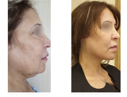 Lifting cervico-facial, lipofilling, platysmaplastie et liposuccion du cou