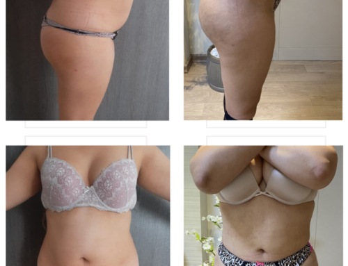 Liposculpture & BBL