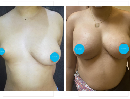 Correction d’une asymétrie mammaire avec prothèses, lifting et injection de graisse