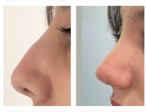 Rhinoplastie