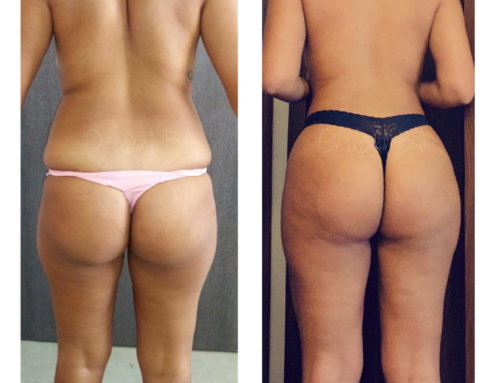 Liposculpture vaser