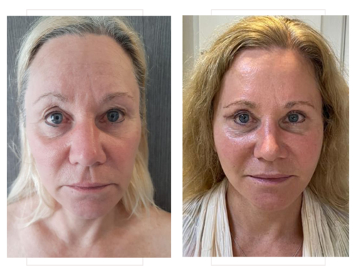 Lifting cervico-facial & blépharoplastie supérieure