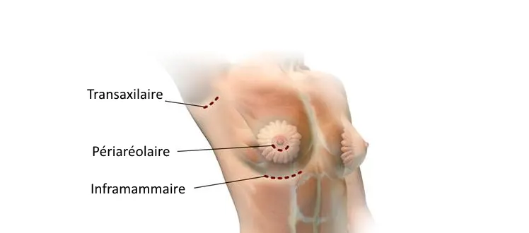 incisions augmentation mammaire tunisie dr balti