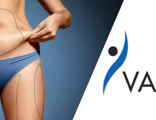 Les réponses à  vos questions au sujet de la liposuccion Vaser