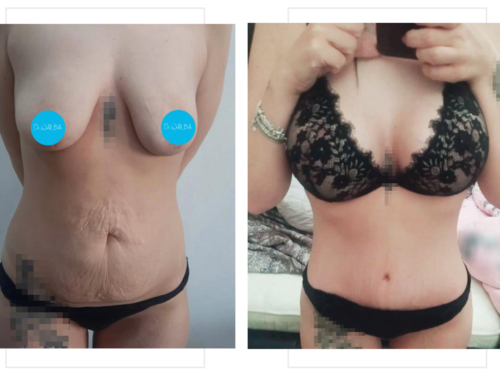 Lifting mammaire avec prothèses & abdominoplastie