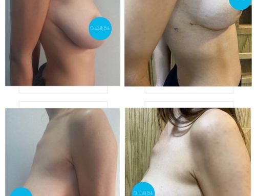 Lifting des seins sans implants
