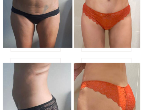 Liposuccion & abdominoplastie