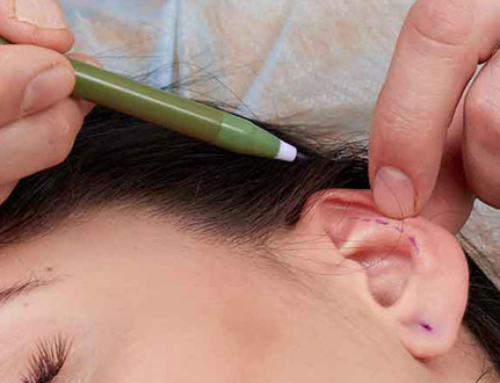 L’action de l’otoplastie sur le cartilage de l’oreille