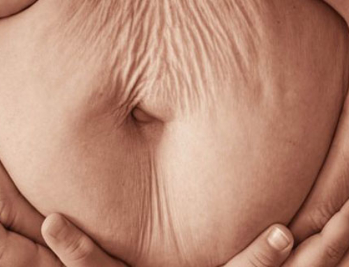 L’abdominoplastie pour traiter les bourrelets de peau, le diastasis et autres imperfections du ventre