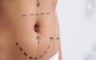 Comment savoir si vous pouvez bénéficier d’une liposuccion