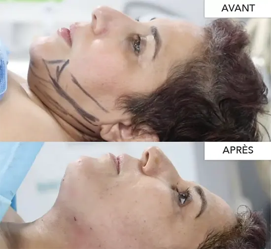 morpheus8 avant apres tunisie morpheus8 avant apres tunisie