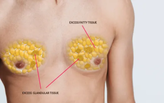 La liposuccion HD offre-t-elle une nouvelle option de traitement de la gynécomastie