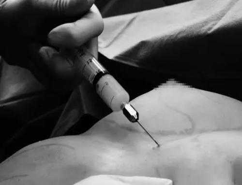 Lipofilling des seins : ses avantages comparés à ceux des implants mammaires
