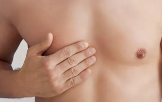 Gynécomastie ou surcharge graisseuse au niveau des seins chez l’homme comment faire la distinction