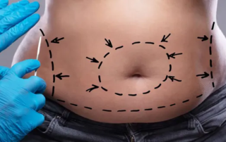 Faut-il perdre du poids avant une abdominoplastie ?